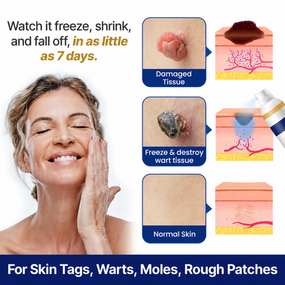 Chillerase Bump Renewal Spray: Safe, Fast Cryotherapy Wart Removal At Home