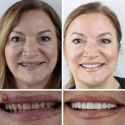 🏆Ends Today: Exclusive Smile Care Offer! 🏆2026 Bestselling Product🦷 Fresh Smile Comfort, Say Goodbye to Wearing Discomfort!🌎