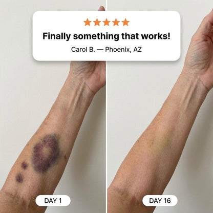 💥KLENIMORE® Bruise Repair & Skin-Strengthening Cream for Fragile Skin